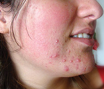 Before Treatment